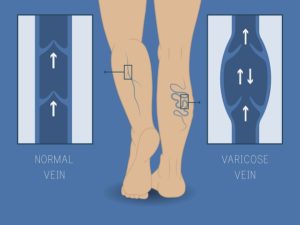 normal vein and varicose vein