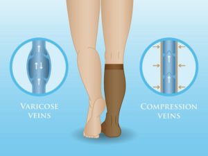 varicose veins and compression stockings